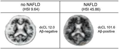 Sex-specific relationship between non-alcoholic fatty liver disease and amyloid-β in cognitively unimpaired individuals